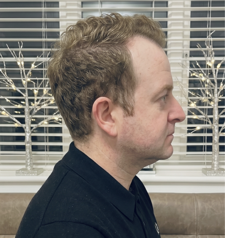 Craig — before, side profile