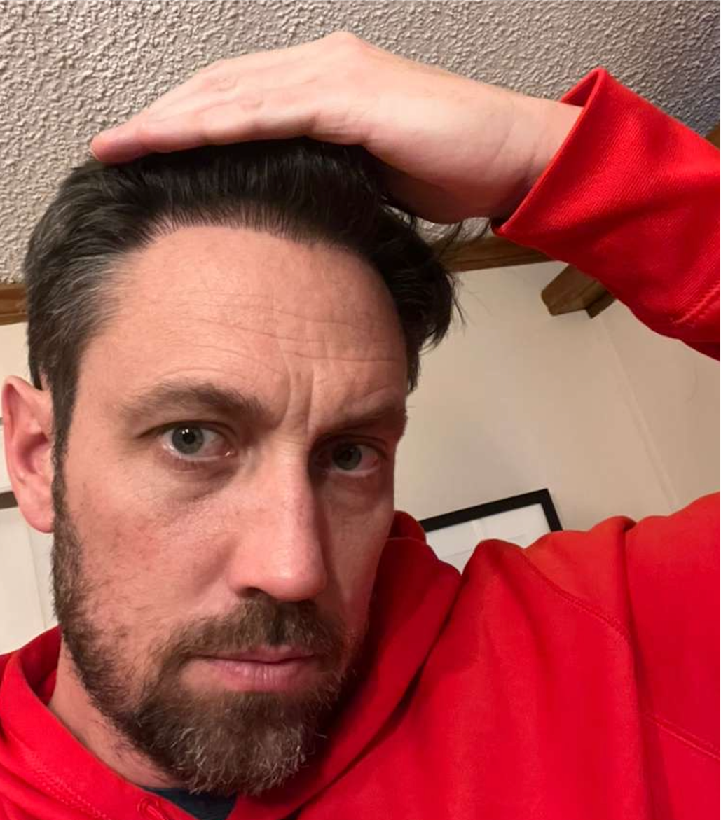 Curtis — after, hairline detail