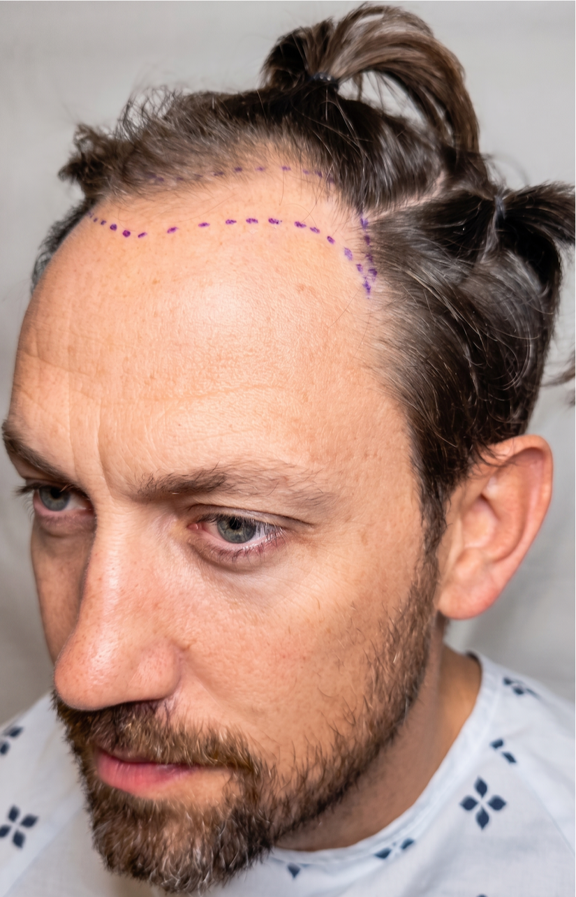 Curtis — before, hairline mapping