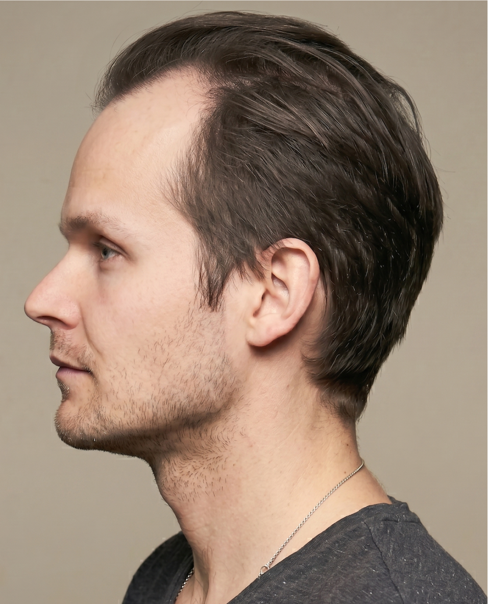 Nick — before, side profile